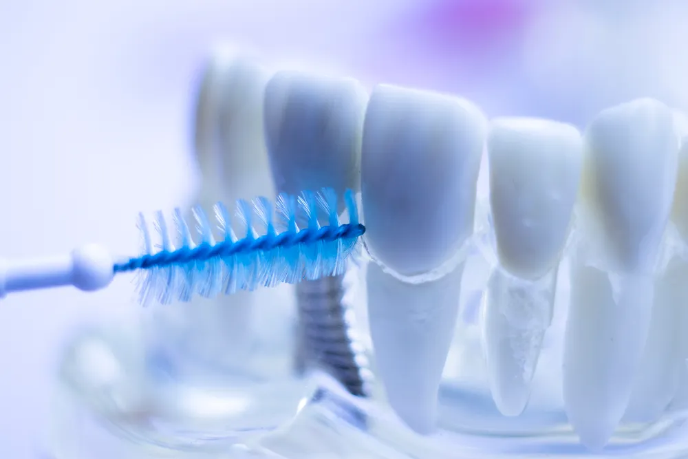 Les avantages des brosses interdentaires pour les dents